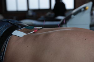 physical therapy acupuncture